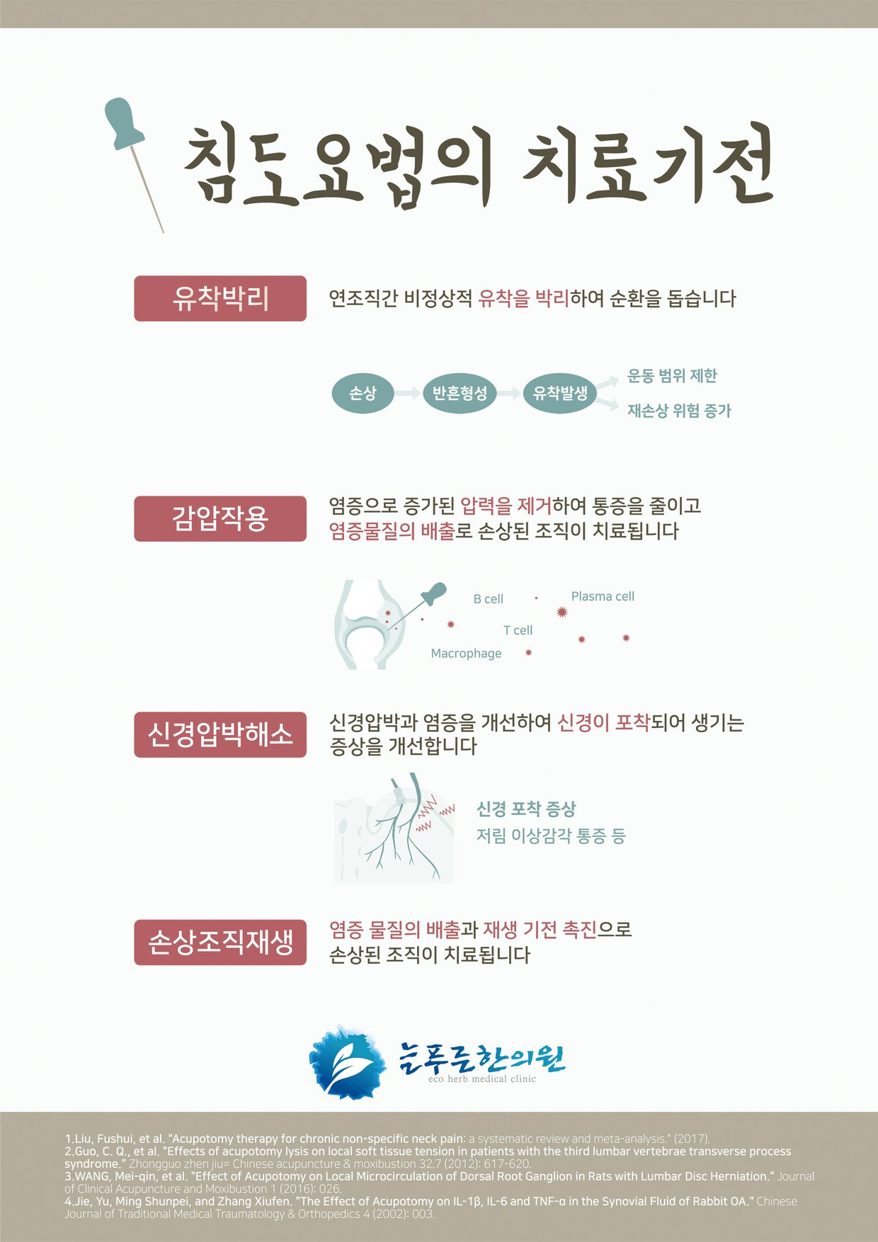 침도요법의 4대 치료기전 인포그래픽 — 유착박리, 감압작용, 신경압박해소, 손상조직재생을 그림으로 설명한 늘푸른한의원 제작 자료